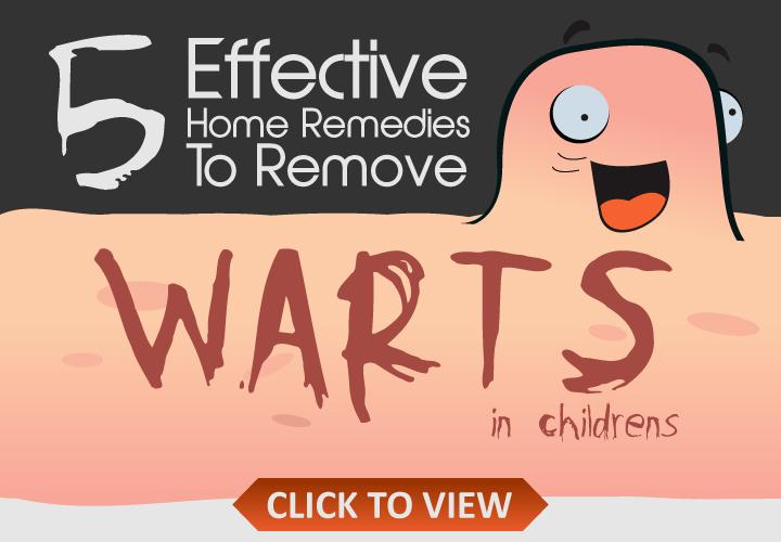 12 Symptoms And Effective Treatment Of Warts In Children