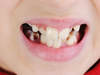5 Serious Causes Behind Discolored Teeth In Children