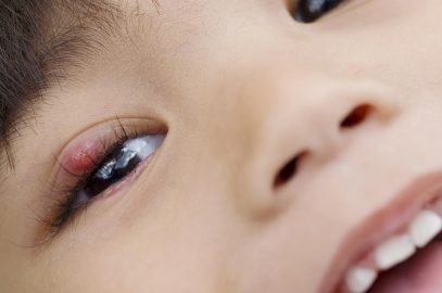 6 Preventive Tips For Stye In Children And Home Remedies