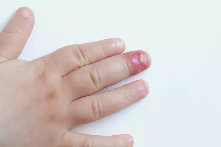 An infected splinter wound can cause inflammation