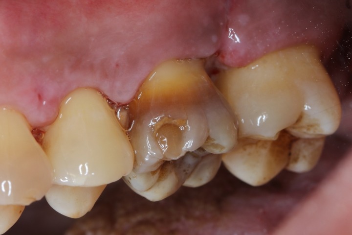 Tetracycline can cause teeth discoloration