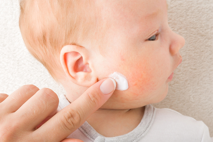 Antifungal creams can treat ringworm in babies