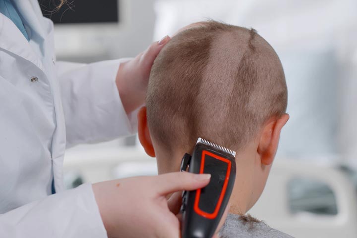 Chemotherapy causes hair loss in toddlers with cancer