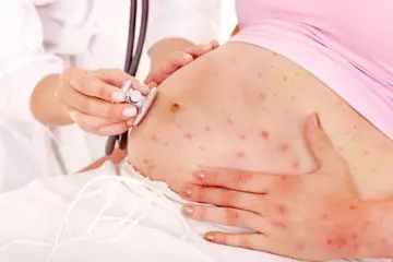 Chickenpox During Pregnancy - Causes, Symptoms, Risks & Treatments