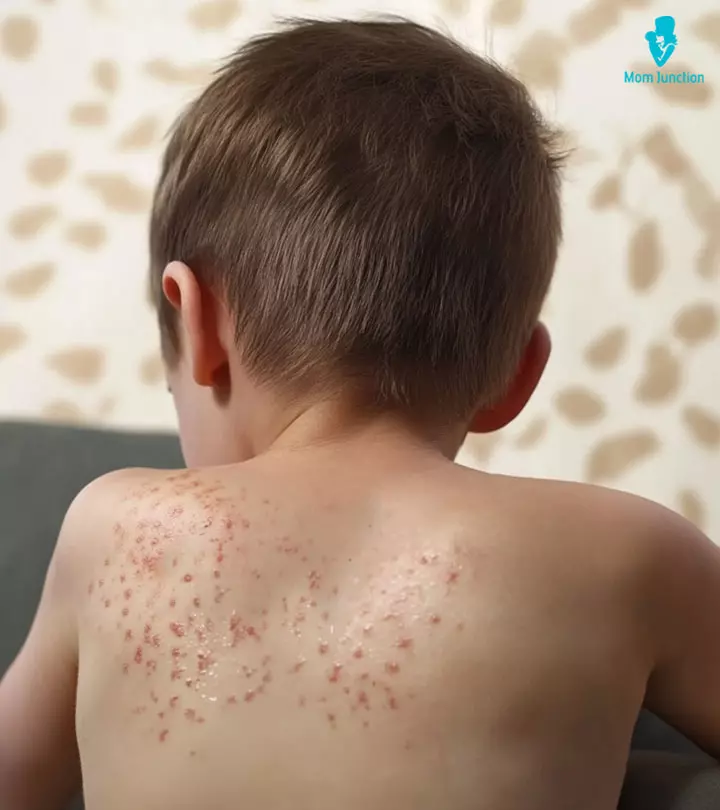 Child-With-Visible-Heat-Rashes-On-Their-Skin