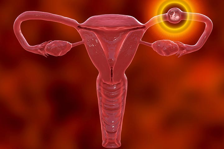 Ectopic pregnancy occurs in the early stages