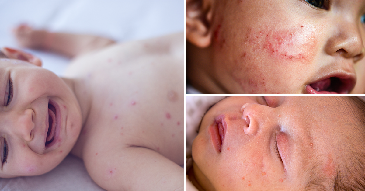 11-effective-treatments-to-cure-heat-rash-in-toddlers