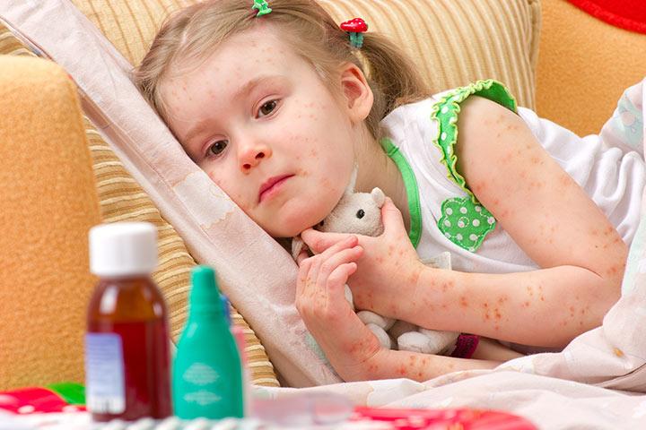 Folliculitis In Children Causes Symptoms And Treatment