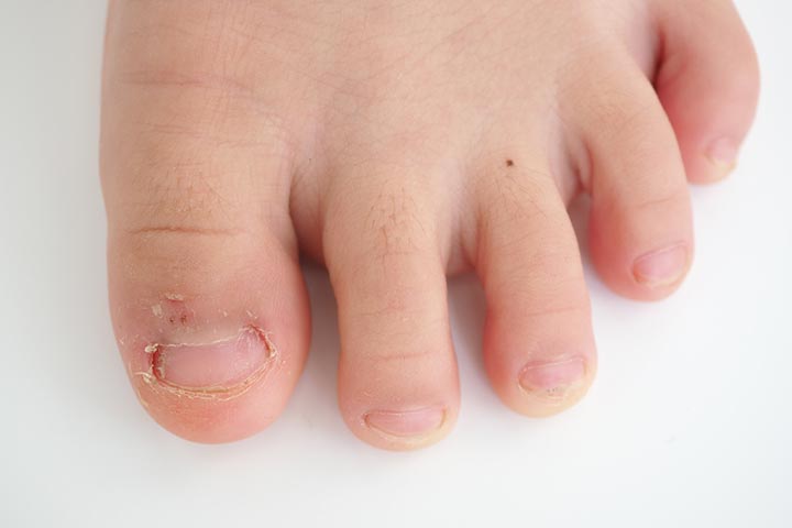 Fungal infections may lead to ingrown toenails in kids
