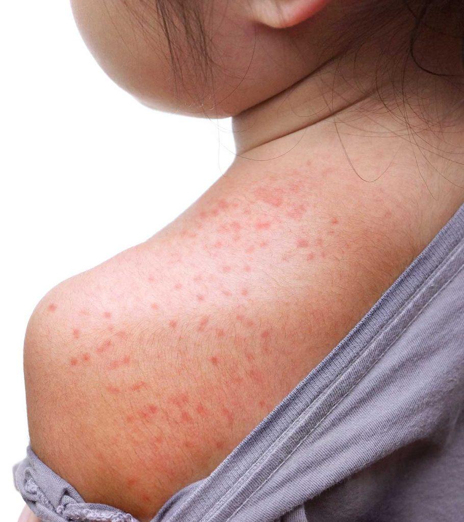 Heat rash in kids