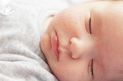 Impetigo In Babies: Causes, Symptoms, Diagnosis And Treatment