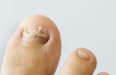 What Causes Ingrown Toenails In Kids And How To Treat It?