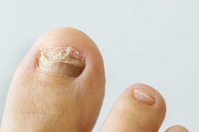What Causes Ingrown Toenails In Kids And How To Treat It?