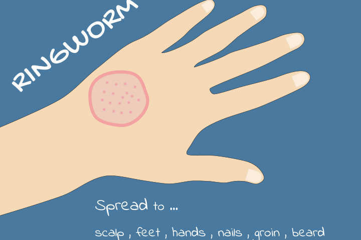 Ringworm In Kids Types Causes Symptoms Treatment And Care Momjunction