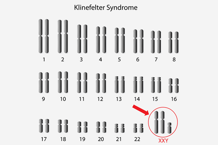 Klinefelter syndrome in babies with extra chromosomes