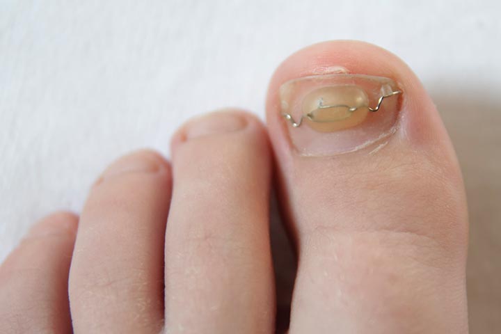 Nail braces help treat ingrown toenails in kids.