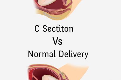 C-Section Vs. Normal Delivery: How Are They Different