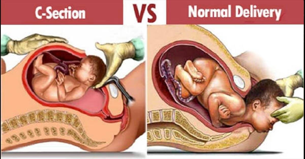c section versus vaginal C section versus vaginal