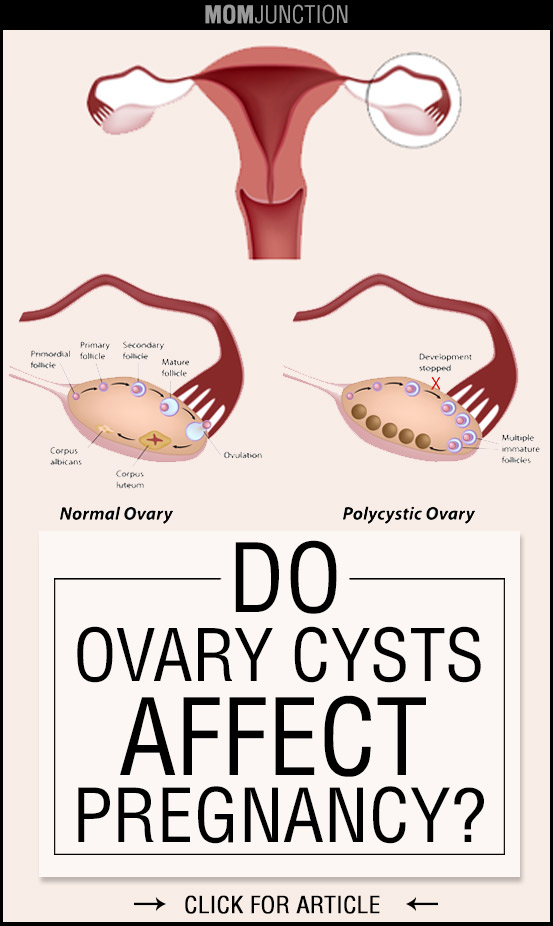 Can Ovarian Cysts Prevent Pregnancy?