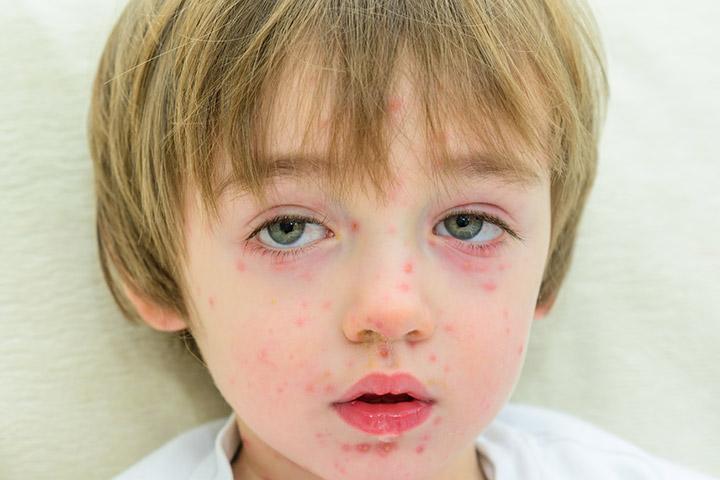 papular-urticaria-in-children-causes-symptoms-treatment