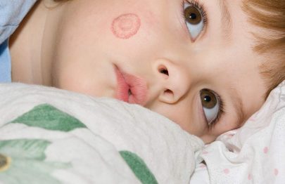 Ringworm In Kids: Types, Causes, Symptoms, Treatment & Care