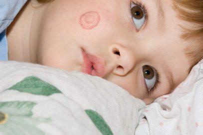 Ringworm In Kids: Types, Causes, Symptoms, Treatment & Care