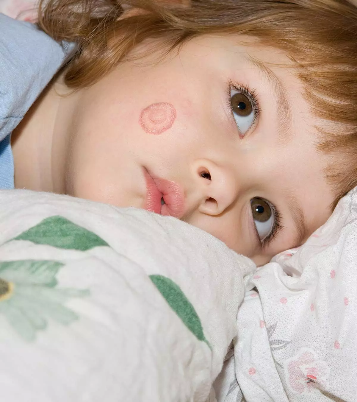 Ringworm In Kids Causes, Symptoms And Treatment