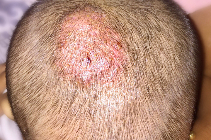 Ringworm in babies can occur on the scalp