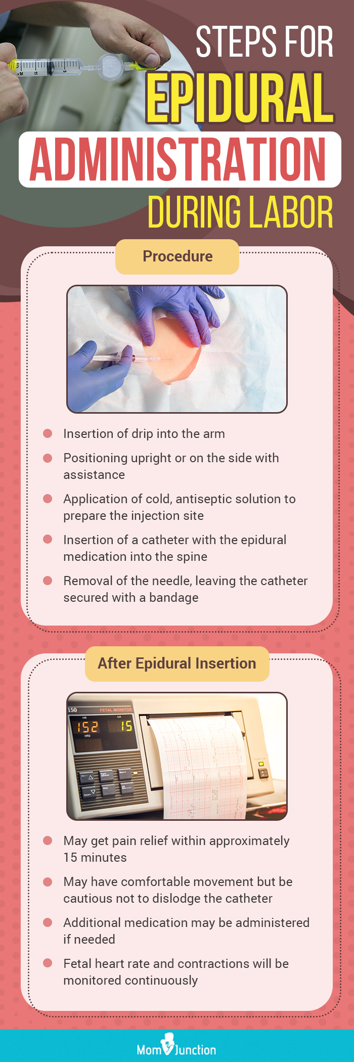 steps for epidural administration during labor (infographic)
