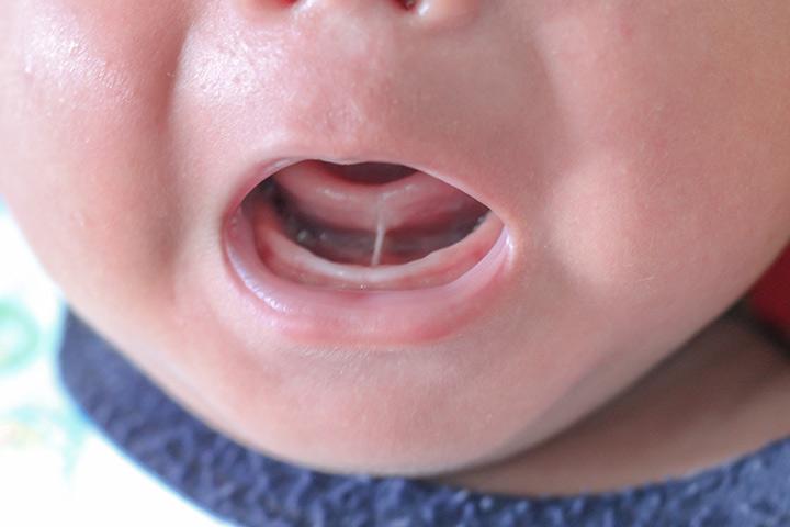 tongue-tied-baby-ankyloglossia-causes-symptoms-treatment