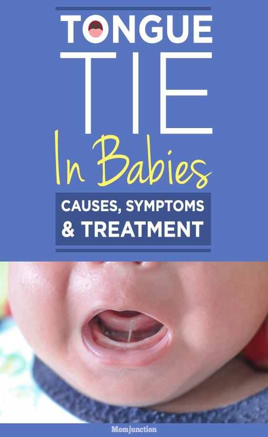Tongue Tie In Babies Causes, symptoms And Treatment