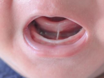 Tongue Tie In Babies: Causes, symptoms And Treatment