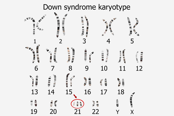 Down syndrome karyotype in babies with extra chromosomes
