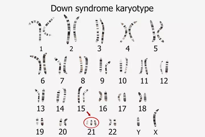 Down syndrome karyotype in babies with extra chromosomes