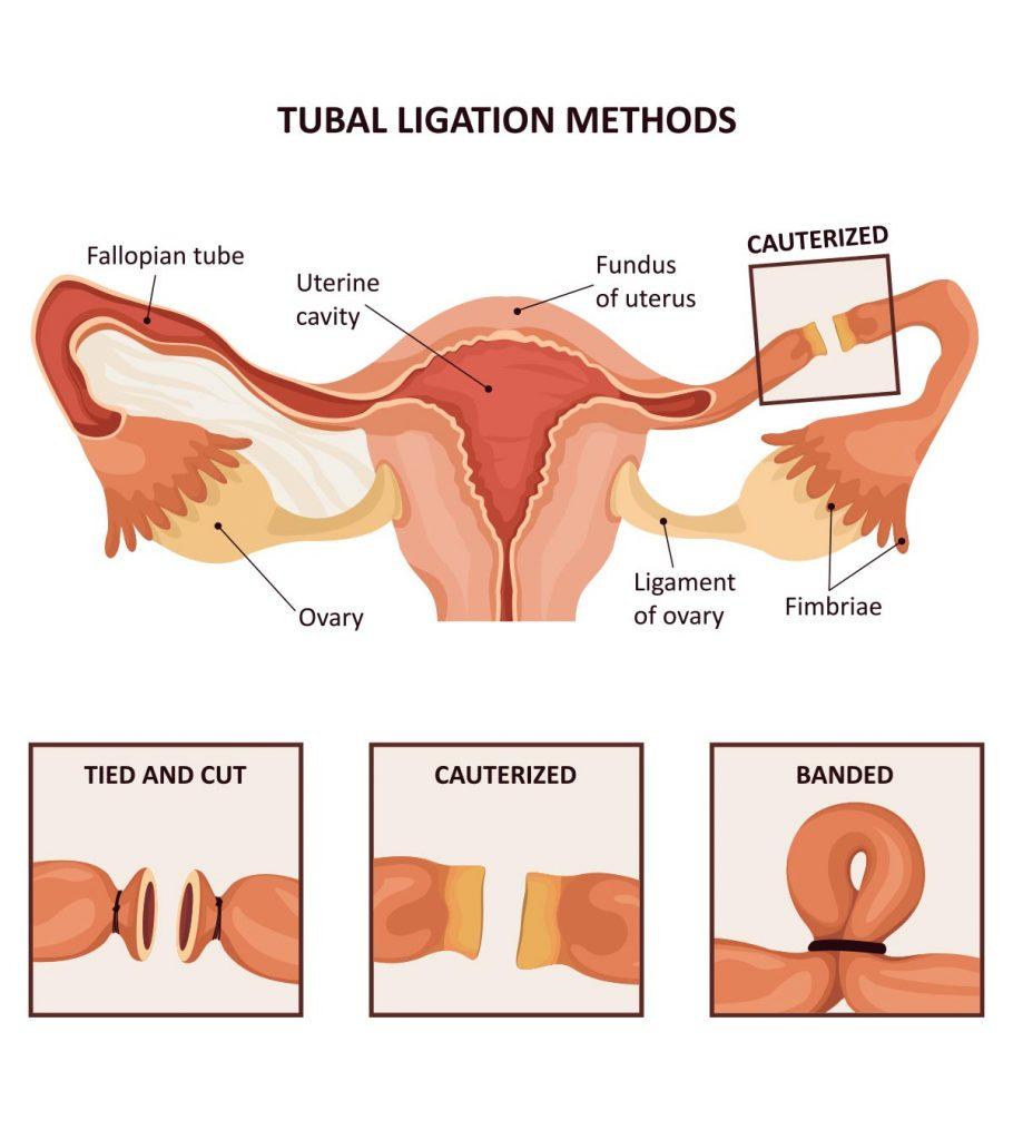 bilateral tubal ligation