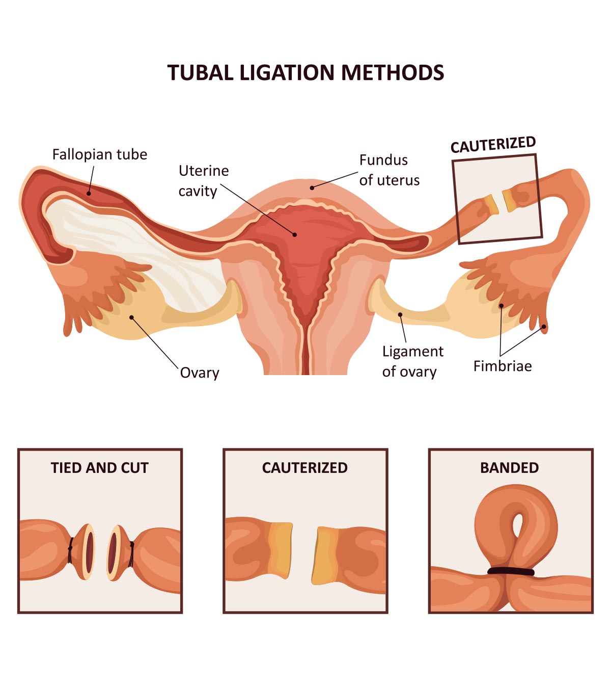 Tubal Ligation: What It Is, Procedure, Benefits And Risks