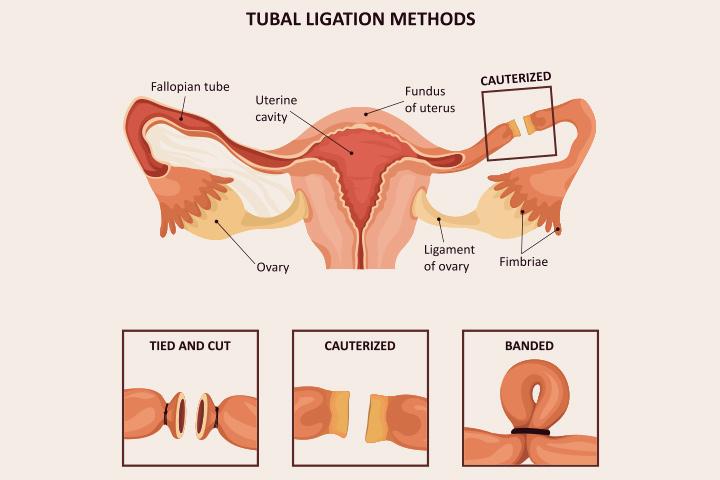 tubal-ligation-benefits-risks-and-alternatives