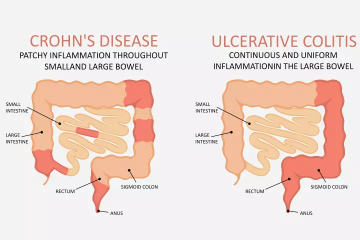 Ulcerative colitis and Crohn’s disease are inflammatory bowel diseases