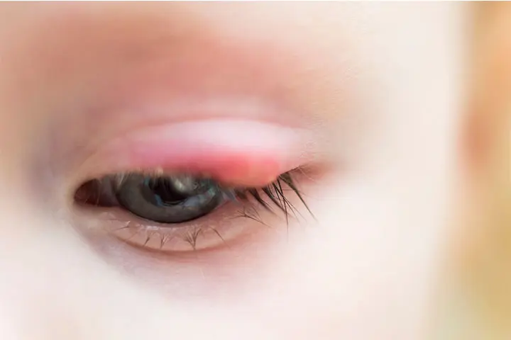 What does a stye in children look like