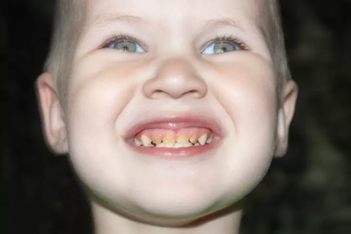 Enamel deffects may cause yellow teeth in children