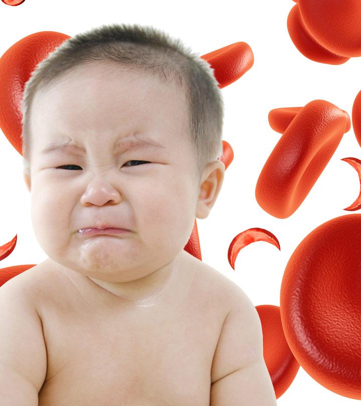 sickle-cell-anemia-symptoms-causes-symptoms-and-treatment-of-sickle