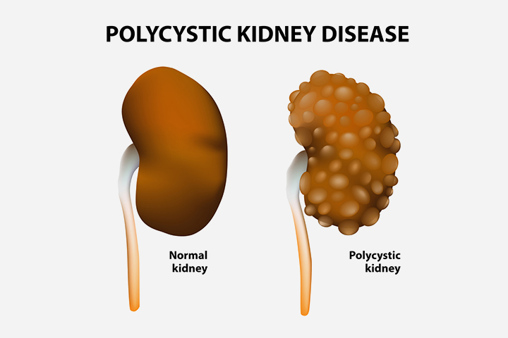 Antibiotics can help treat UTIs in children with polycystic kidney disease