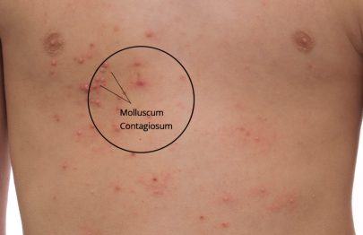 Molluscum Contagiosum In Children: Signs, Causes & Treatment