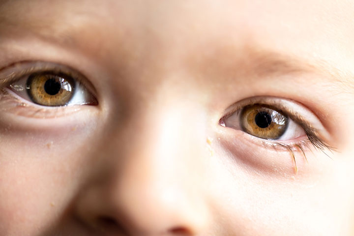 Crusted eyelashes may be a sign of blepharitis in babies.