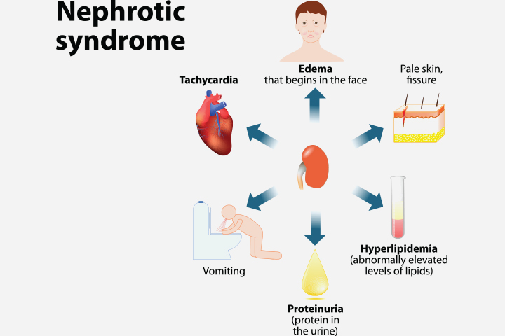 Nephrotic syndrome in children