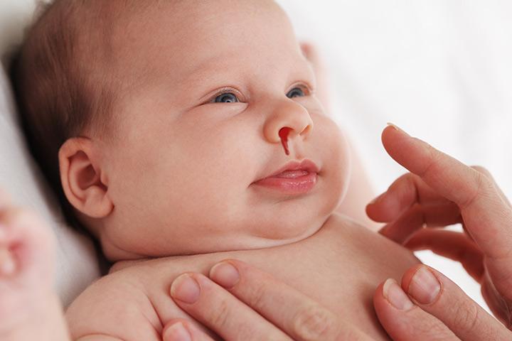 11 Simple Steps To Soothe Nose Bleeding In Babies