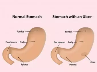 7 Symptoms Of Stomach Ulcer In Children: Causes & Treatment