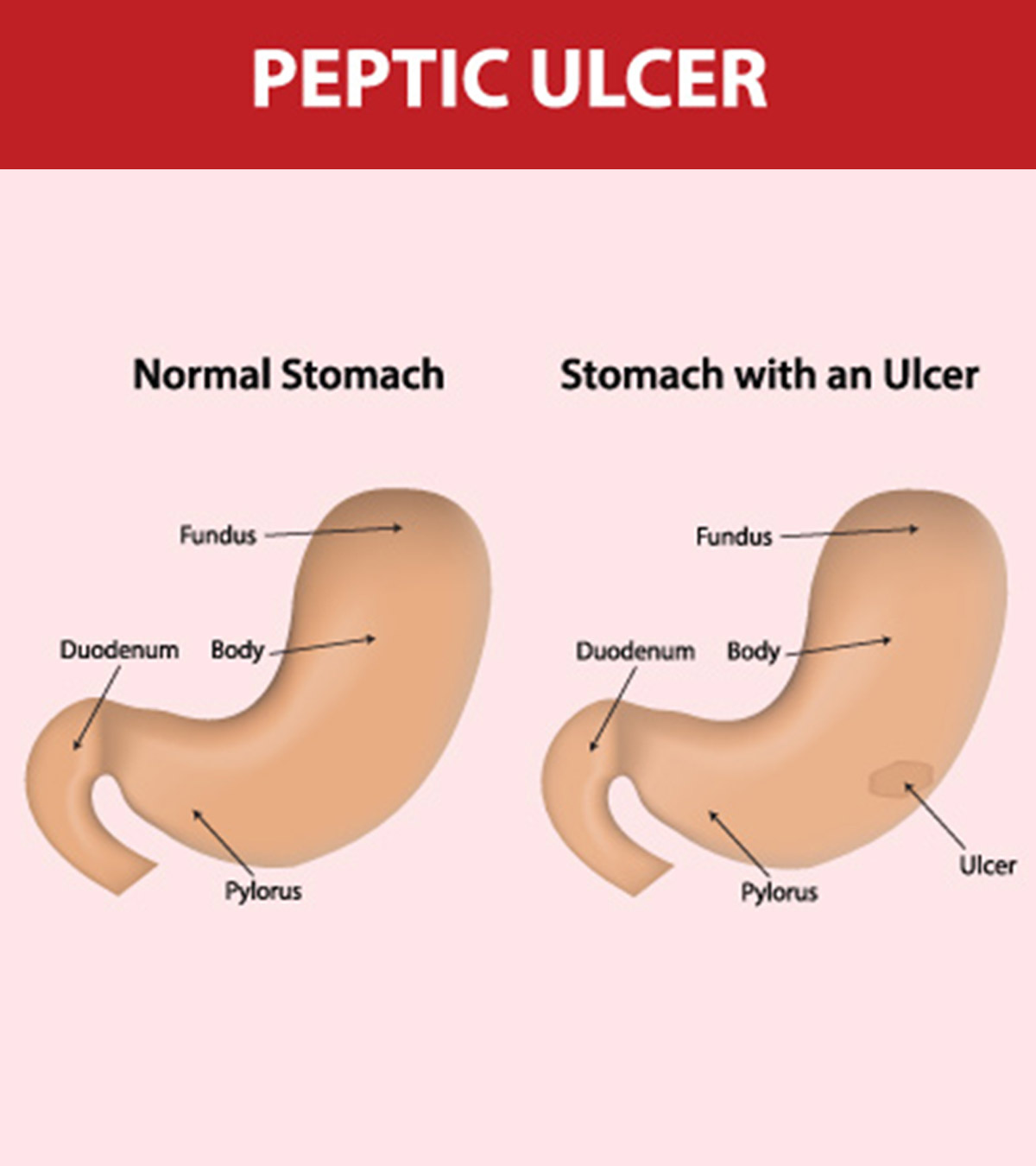 7 Symptoms Of Stomach Ulcer In Children: Causes & Treatment