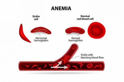 7 Early Signs And Symptoms Of Sickle Cell In Babies