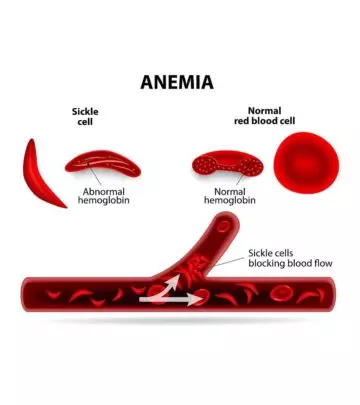 Sickle-Cell-Disease-(SCD)-In-Babies-Symptoms,-Causes,-And-Treatment.,jpg